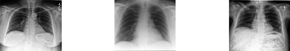 radiographies pulmonaires
